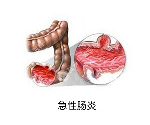 急性肠炎