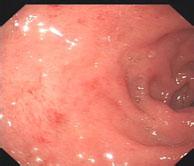 如何自我诊断浅表性胃炎