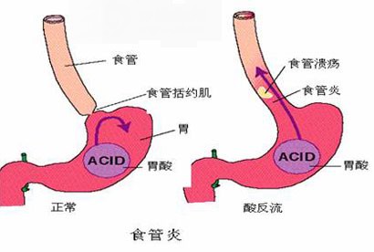 反流性胃炎