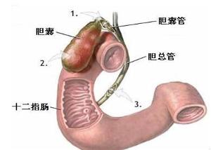 十二指肠溃疡