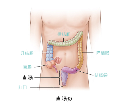 直肠炎