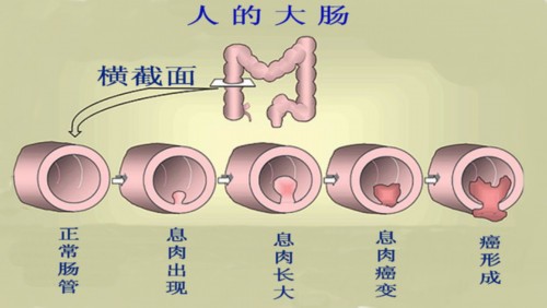 肠息肉