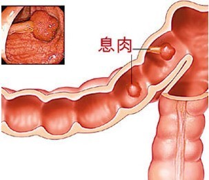 肠息肉